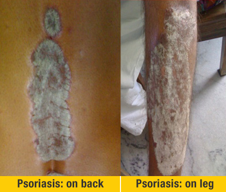 Before Treatment Psoriasis on Back And Leg